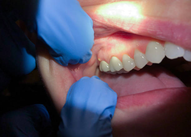 Best Emergency Broken Tooth Repair in Mathews, LA